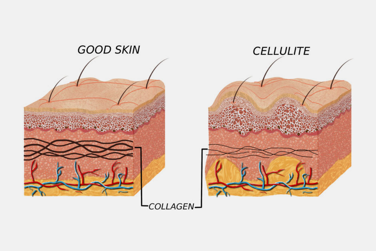 Some-Important-Facts-About-Cellulite,-Collagen,-and-Beautiful-Skin